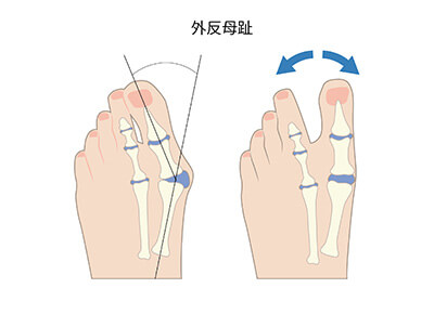 外反母趾の原因
