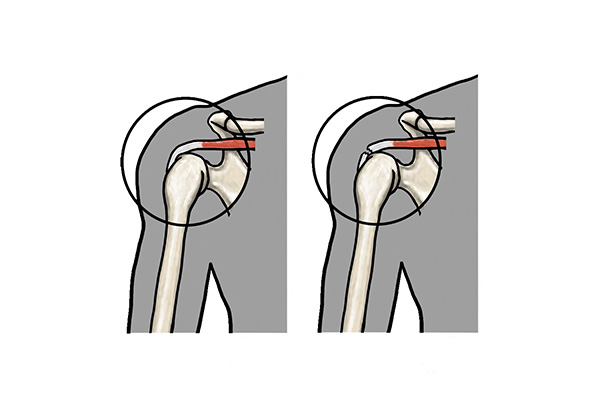 腱板損傷の治療