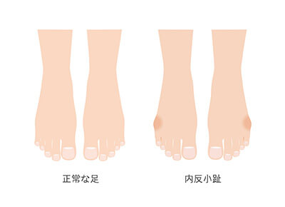 内反小趾の原因