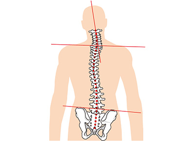 骨格の歪みで引き起こされる腰痛の原因